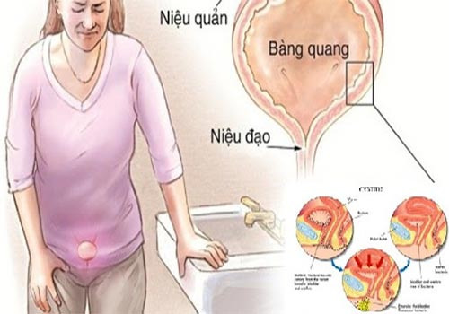 Bệnh viêm niệu đạo có nguy hiểm không? - Phòng Khám Đa Khoa An Giang