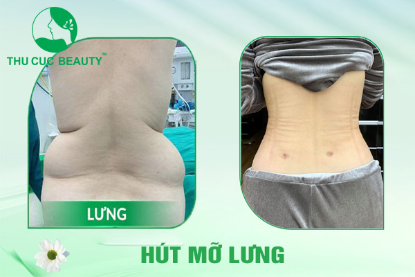 Hút mỡ lưng - Thu Cúc Sài Gòn