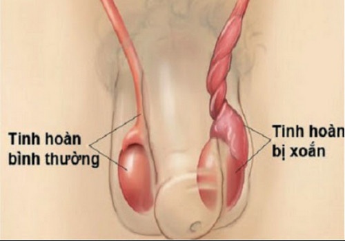 Địa chỉ thăm khám uy tín và chi phí điều trị xoắn tinh hoàn bao nhiêu tiền | Phòng Khám Đa Khoa An Giang