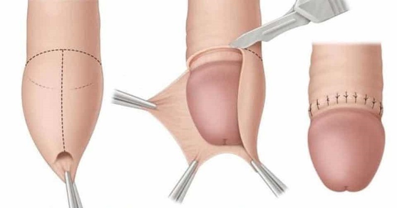 [ GIẢI ĐÁP ] Cắt bao quy đầu có đau không & các phướng pháp an toàn