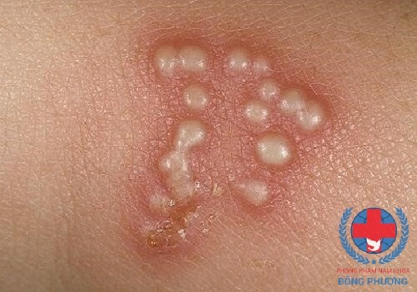 Chữa sùi mào gà ở đâu tốt nhất Hà Nội - Chuyên gia tư vấn