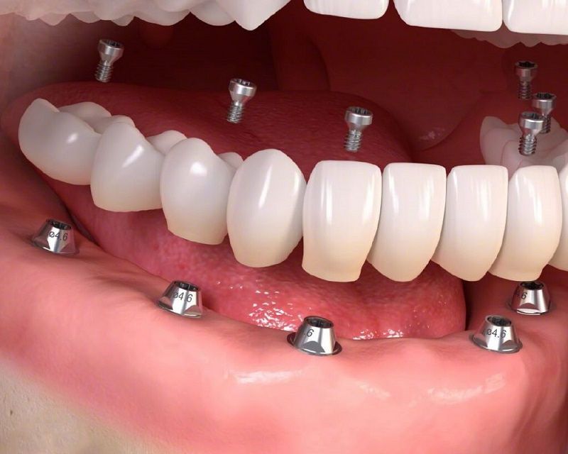 Những điều cần lưu ý trước khi trồng răng implant