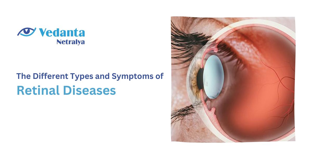 The Different Types and Symptoms of Retinal Diseases