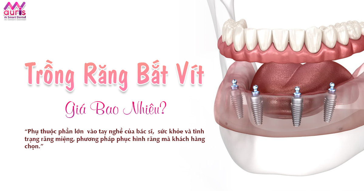 Trồng răng bắt vít giá bao nhiêu - Nha Khoa My Auris