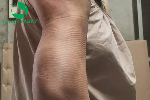 Hút mỡ bắp tay bị lồi lõm - Thẩm mỹ Thu Cúc