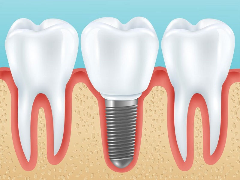 Cắm ghép implant có đau không?