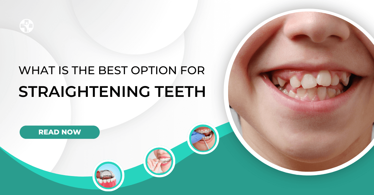What is the Best Option for Straightening Teeth? - Buzz9studio