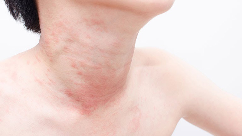 Các hiện tượng dị ứng nổi mề đay - Đa khoa da liễu Đông Phương