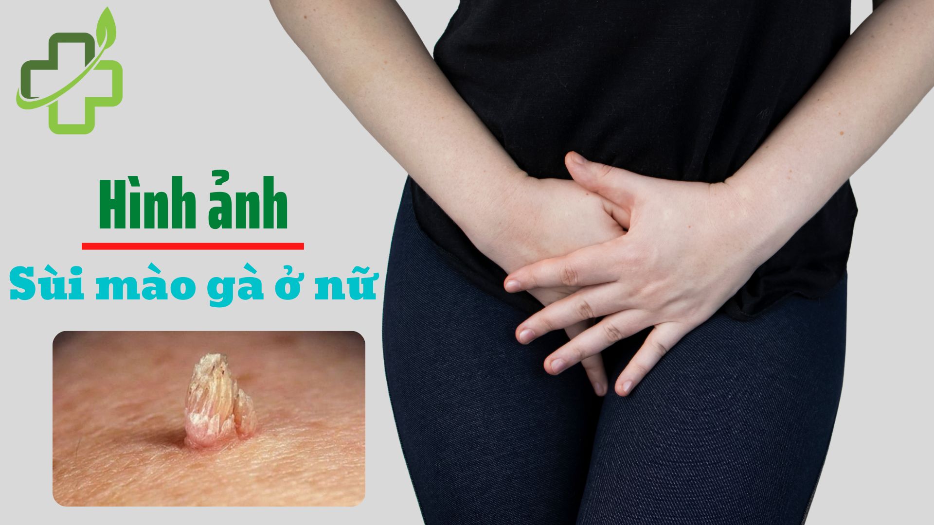 【Hình ảnh】 Âm đạo phụ nữ bị sùi mào gà qua cái giai đoạn
