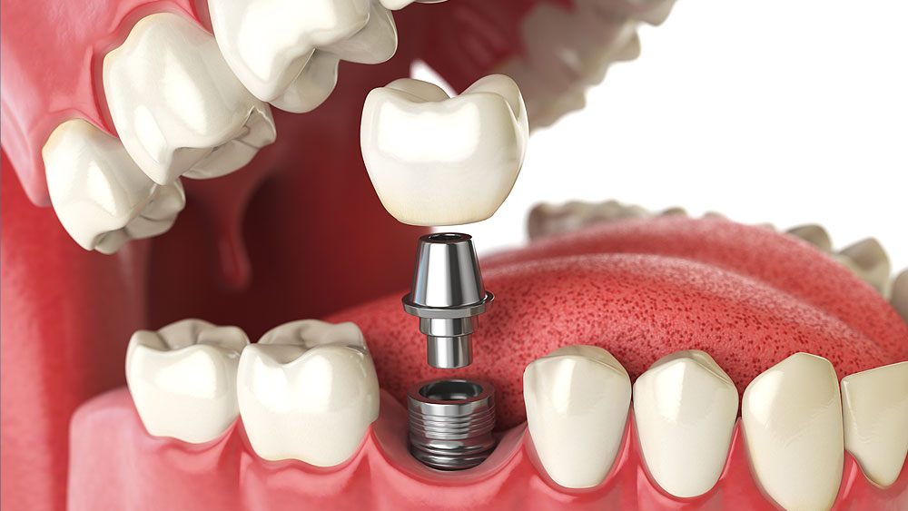 How to Find an Affordable Dental Implant? | Zupyak