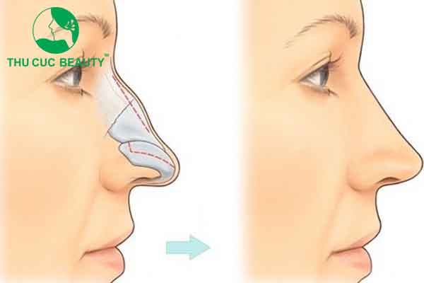 Nâng mũi bọc sụn tai có vĩnh viễn không? - Thẩm mỹ Thu Cúc