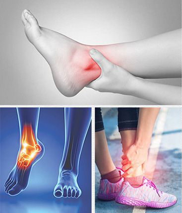 Cách trị căng cơ chân đơn giản, hiệu quả