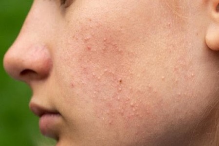 #16 Cách trị mụn ẩn tại nhà hiệu quả chỉ 5 phút mỗi ngày