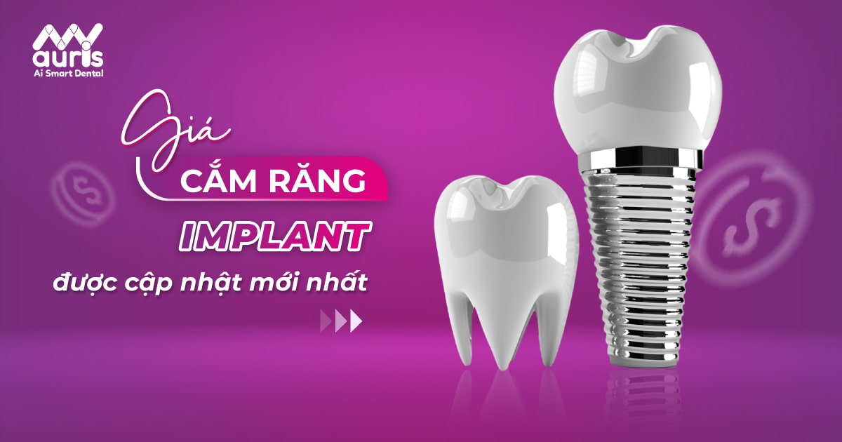 Giá cắm răng implant hết bao nhiêu tiền? - Nha Khoa My Auris