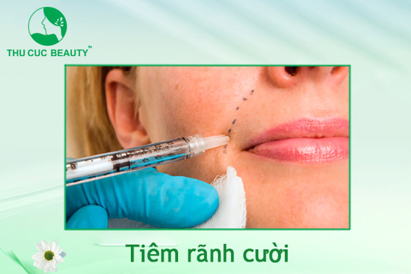 Tiêm rãnh cười - Lấp đầy rãnh nhăn chỉ sau 20 phút