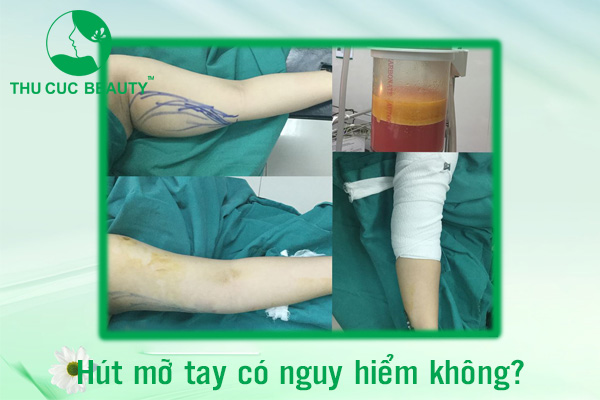 Hút mỡ tay có nguy hiểm không? - Thu Cúc Sài Gòn