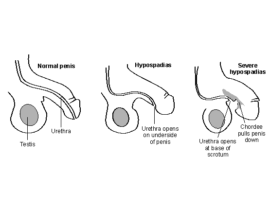 Hypospadias Surgery | Hypospadias Surgery Cost in Pakistan