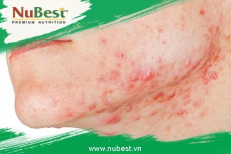 #10 Cách trị mụn nội tiết nhanh hết, an toàn, không đau