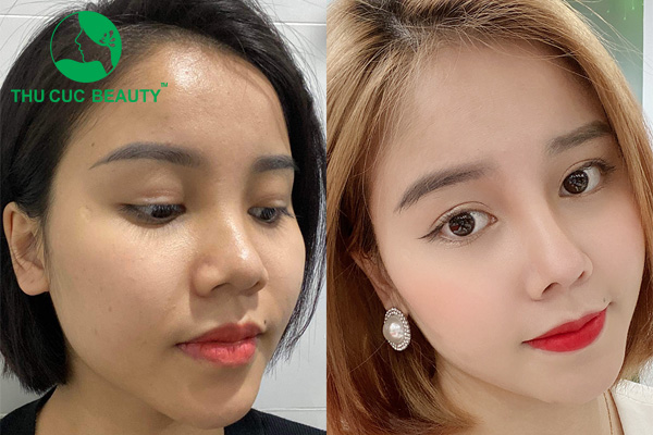 Có nên nâng mũi không? - Thẩm mỹ Thu Cúc