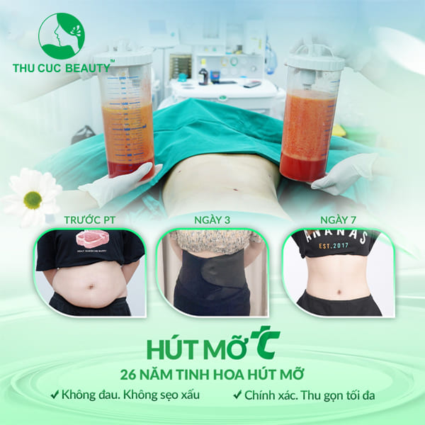 Hút mỡ bụng có tác dụng phụ không? - Thu Cúc Sài Gòn
