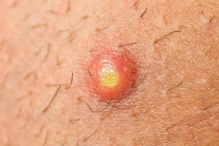 #15 Cách trị mụn mông đơn giản và hiệu quả cao tại nhà