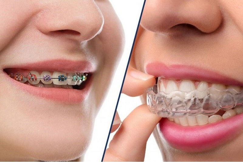 Chỉnh nha không mắc cài có mang lại hiệu quả cao không?