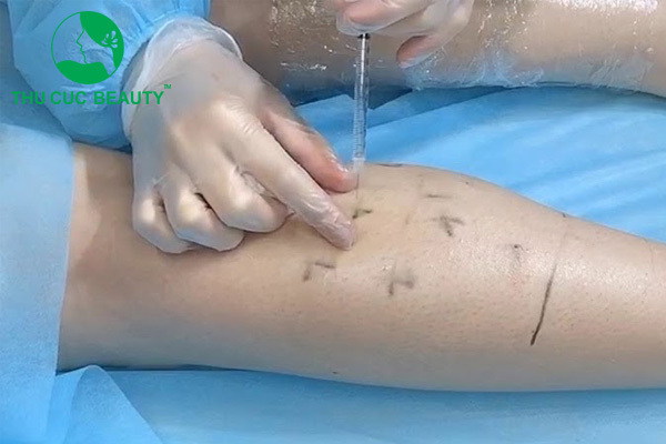 Hút mỡ bắp chân - Thẩm mỹ Thu Cúc