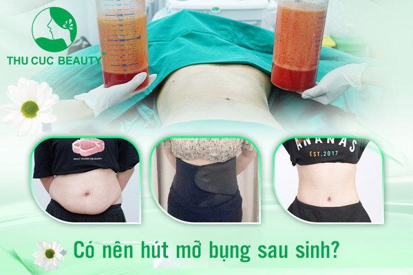 Có nên hút mỡ bụng sau sinh? - Thu Cúc Sài Gòn