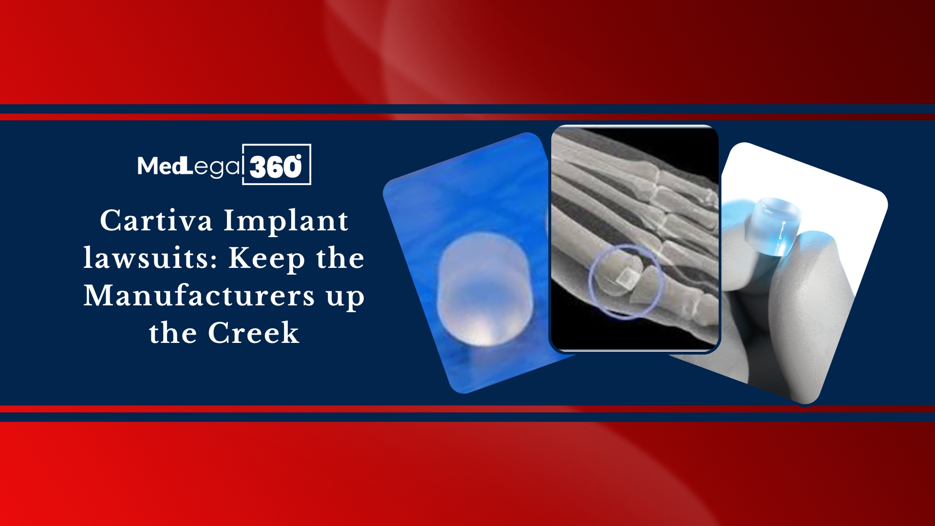 Cartiva Implant Lawsuits: Keep the Manufacturers up the Creek