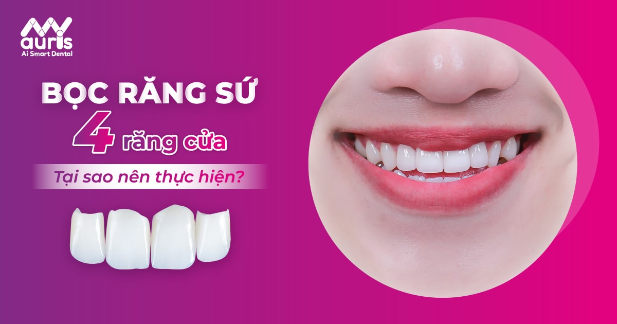 Tại sao nên bọc răng sứ 4 răng cửa?