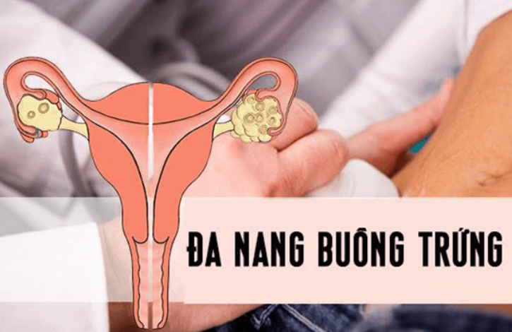 Bệnh Đa Nang Buồng Trứng Có Nguy Hiểm Không