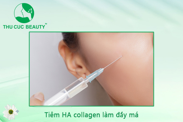 Tiêm HA collagen làm đầy má - Thu Cúc Sài Gòn