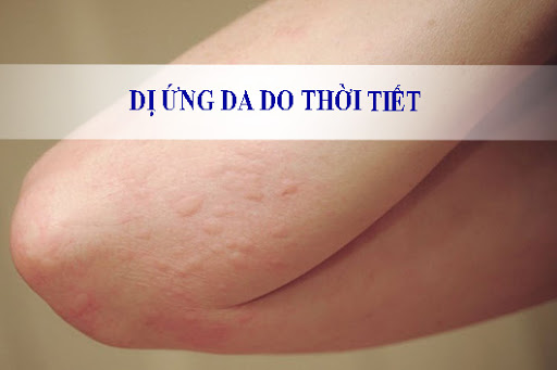 Bệnh ngứa dị ứng thời tiết xuất hiện như thế nào?