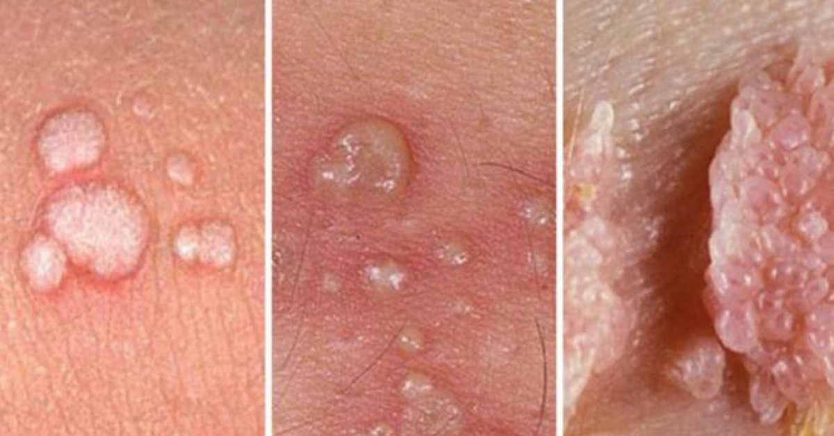 Triệu chứng sùi mào gà - Đa khoa Đông Phương Hà Nội