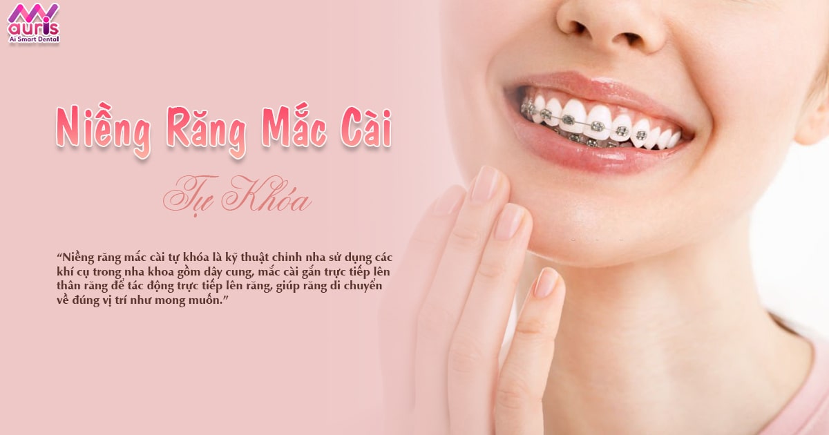 Niềng răng mắc cài tự khóa là gì? Các loại mắc cài tự khóa - Nha Khoa My Auris