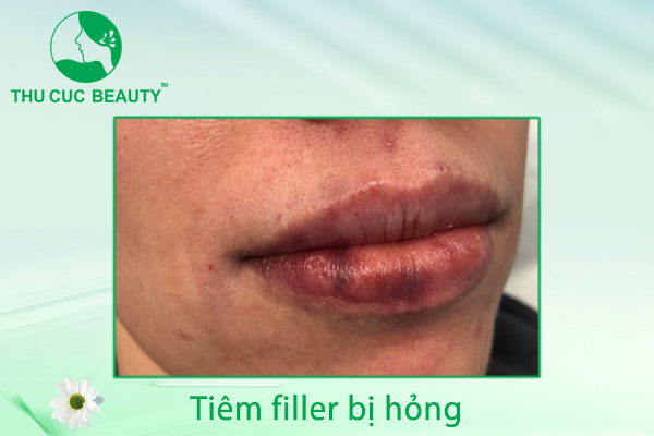 Tiêm filler bị hỏng - Dấu hiệu nhận biết tình trạng