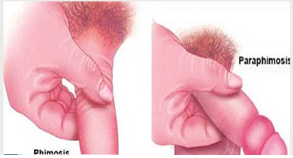 Ảnh hưởng nguy hiểm bệnh viêm bao quy đầu cho nam giới