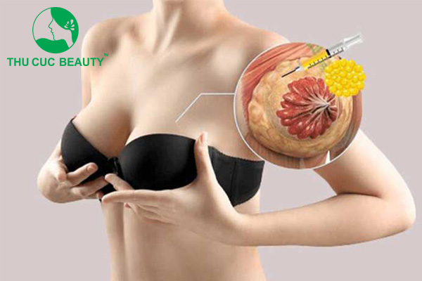 Hút mỡ vòng 1 - Thẩm mỹ Thu Cúc