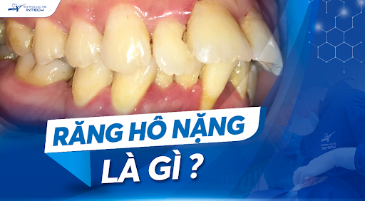 Răng hô nặng là gì? Bật mí cách điều trị hiệu quả nhất