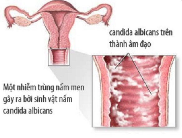 Bệnh nấm vùng kín Dấu hiệu nhận biết và cách điều trị hiệu quả