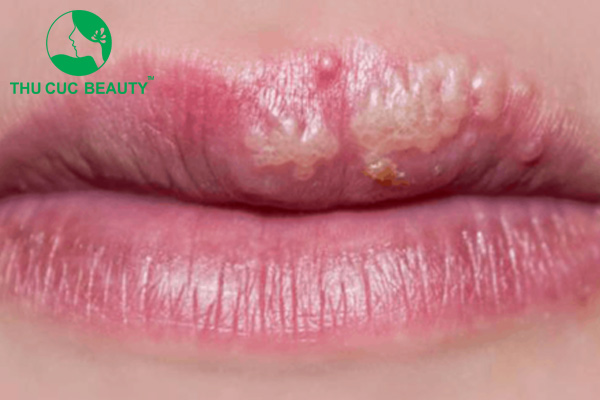 Phun môi bị mụn nước - Nguyên nhân và cách khắc phục