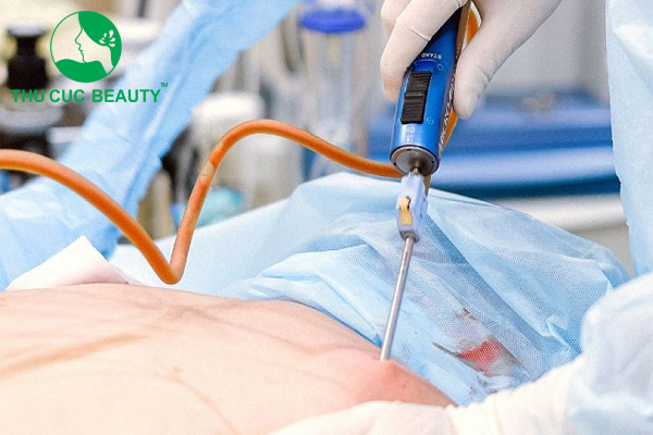 Hút mỡ lưng - Thẩm mỹ Thu Cúc