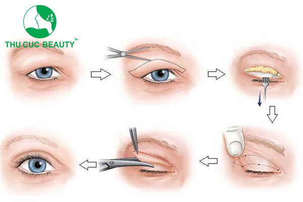 Cắt mí sâu tây - Thẩm mỹ Thu Cúc