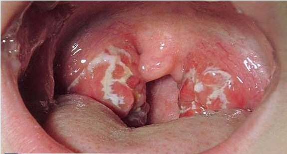 Bệnh lậu và tác hại tiềm ẩn ít người biết