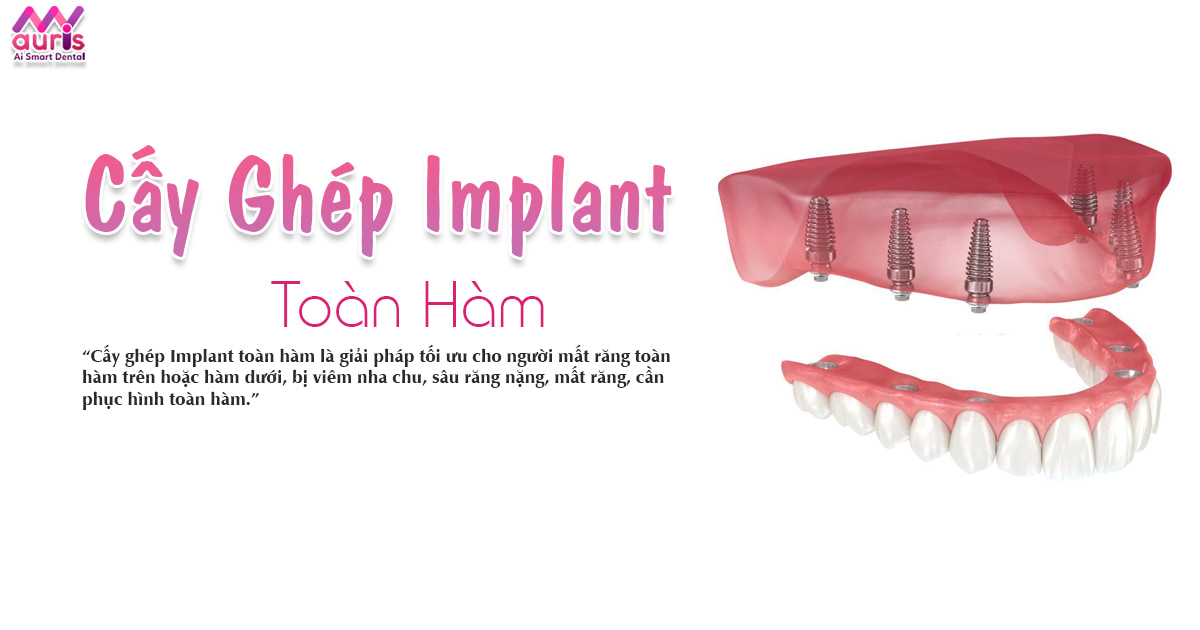 Cấy ghép implant toàn hàm được áp dụng kỹ thuật nào? - Nha Khoa My Auris