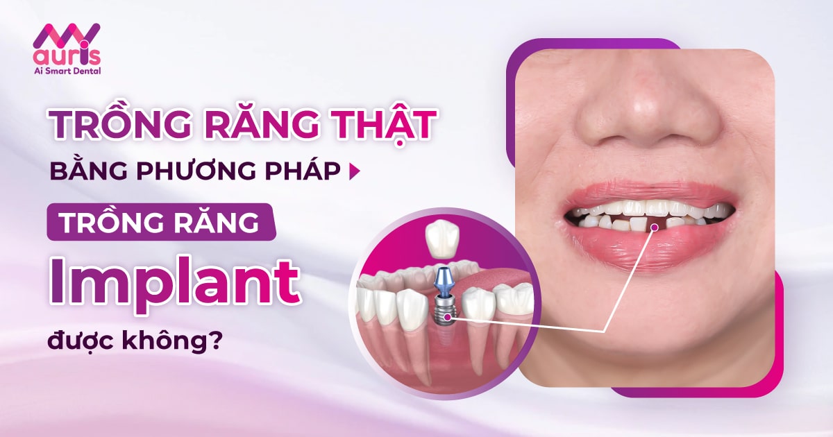 Có nên “trồng răng thật” bằng trồng răng Implant không? - Nha Khoa My Auris