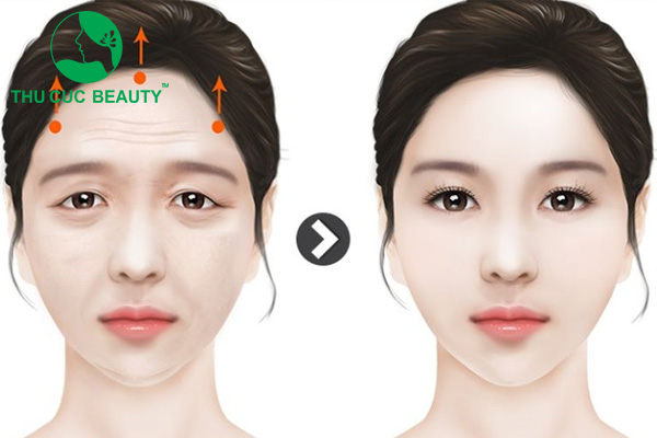 Treo chân mày nội soi và những lưu ý sau khi thực hiện - Thu Cúc Sài Gòn