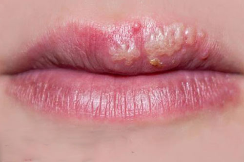 Nhận biết Mụn rộp sinh dục ở môi