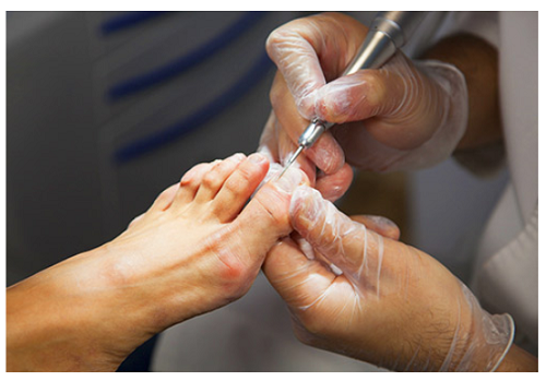 Chữa nấm móng hiệu quả bằng phương pháp nào