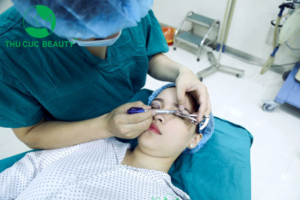 Cắt mí mắt 1 bên - Thẩm mỹ Thu Cúc
